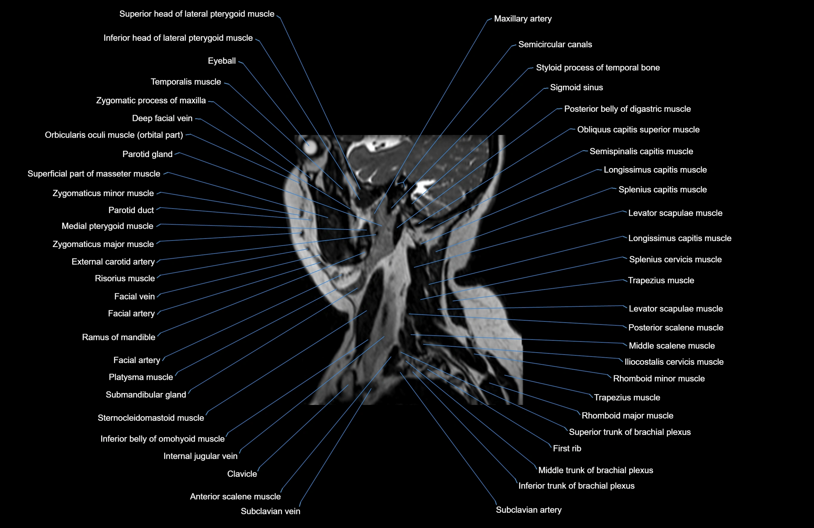 Neck MRI sagittal cross sectional anatomy 3D 1mm 3T radiology  image-img-00001-00026.webp